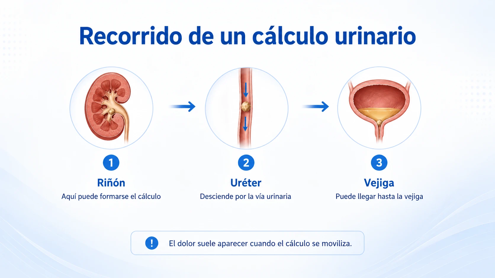 Recorrido del cálculo urinario