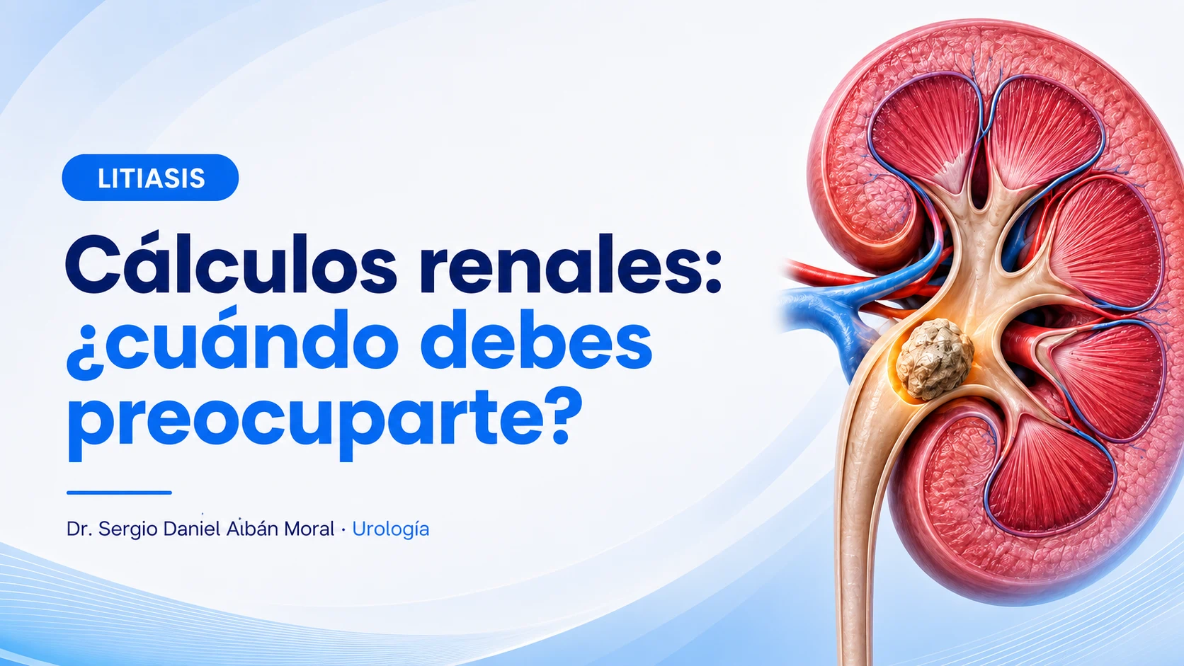 Cálculos renales